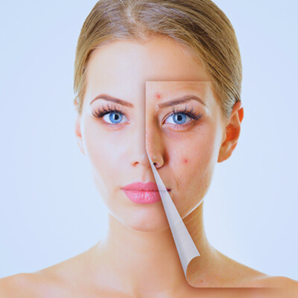 Demystifying Acne: Causes, Treatments, Prevention - Skin Care Solutions