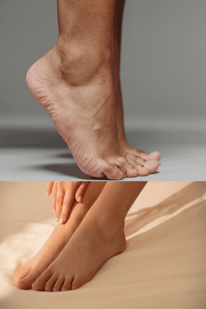 Cracked heel remedy at home . Before and after cracked heels comparison showing dry and smooth skin | skincaresolutions.in