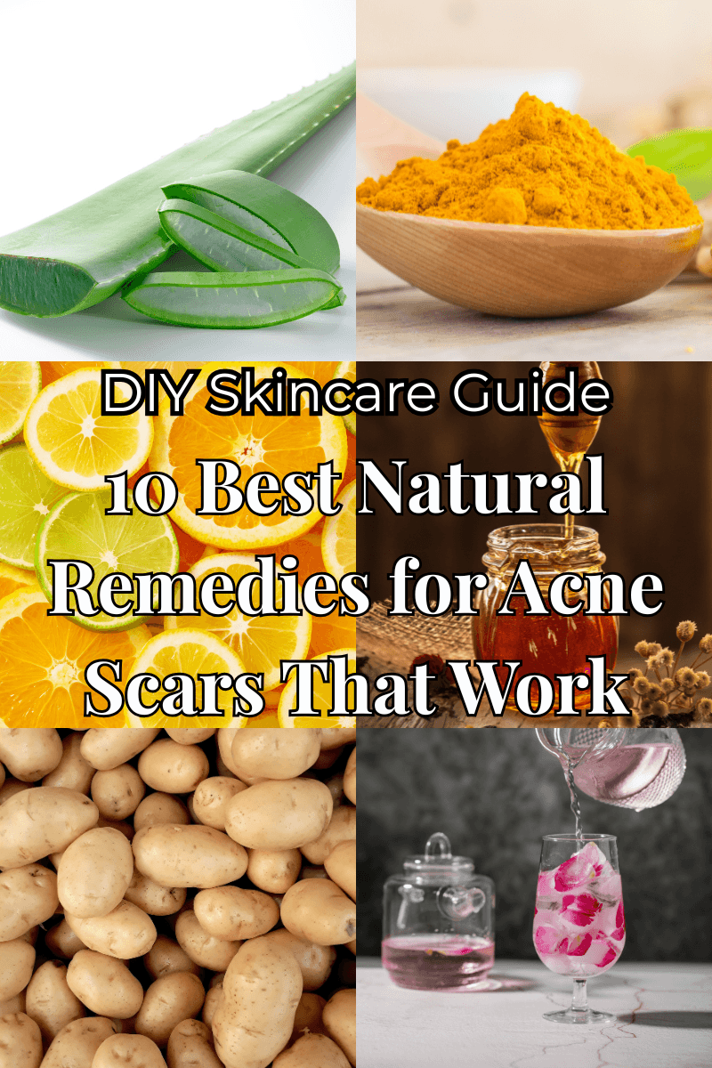 You are currently viewing 10 Best Natural Remedies for Acne Scars That Actually Work Wonders